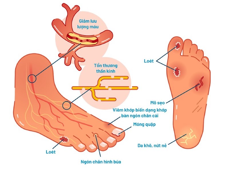 Phòng ngừa biến chứng loét bàn chân do đái tháo đường